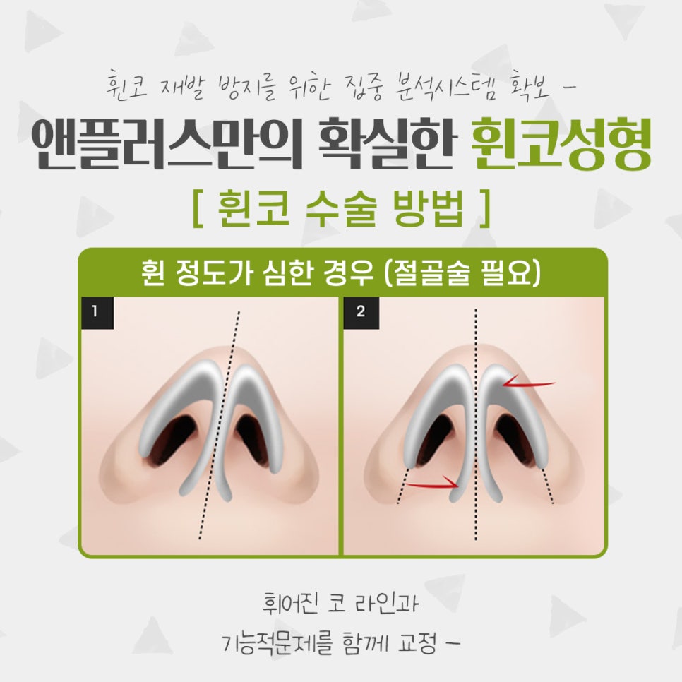 Whistling Nose Surgery Review: A Natural and Beautiful Line image 8