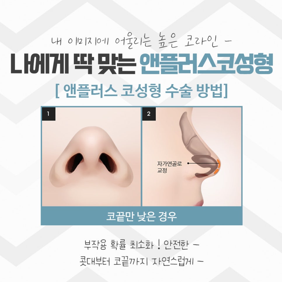 Rhinoplasty Review: Improved with a Refined Line image 10