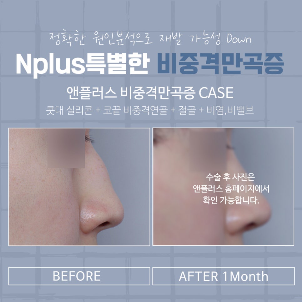 The Importance of Choosing a Septoplasty Review image 4