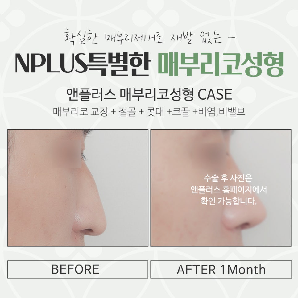 Hump Nose Surgery Review: Check Carefully image 16