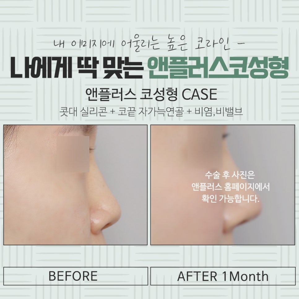 자가연골코수술로 세련되고 자연스럽게 관련 이미지 16