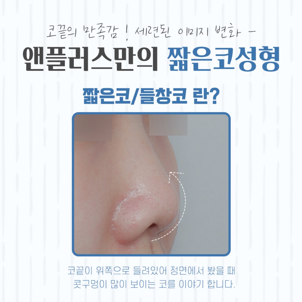A Beautiful Nose Line with Short Nose Surgery image 3