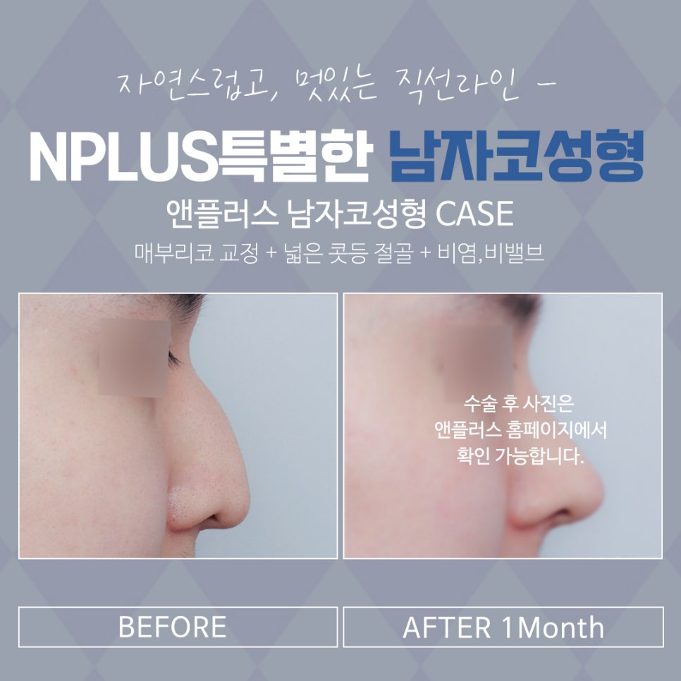 Where to Get Male Rhinoplasty Done Well: Natural and Refined image 15