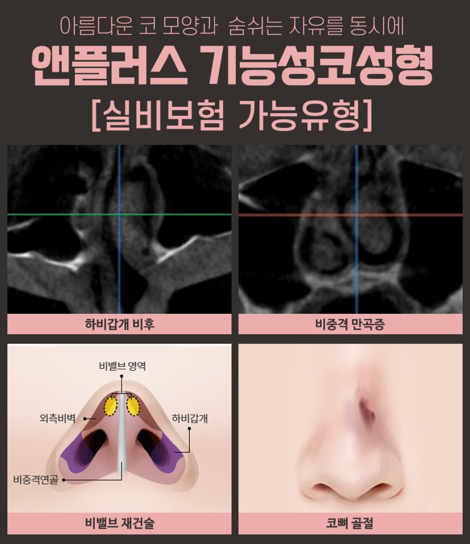 보험이 되는 코성형? 기능성코성형 완벽 정리! 관련 이미지 8