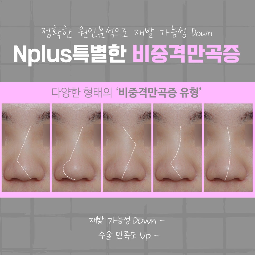 비중격만곡증수술 후기를 알아보고 결정 관련 이미지 7