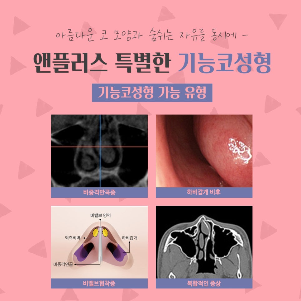 코수술후기 비중격만곡증까지 확인하여 관련 이미지 7