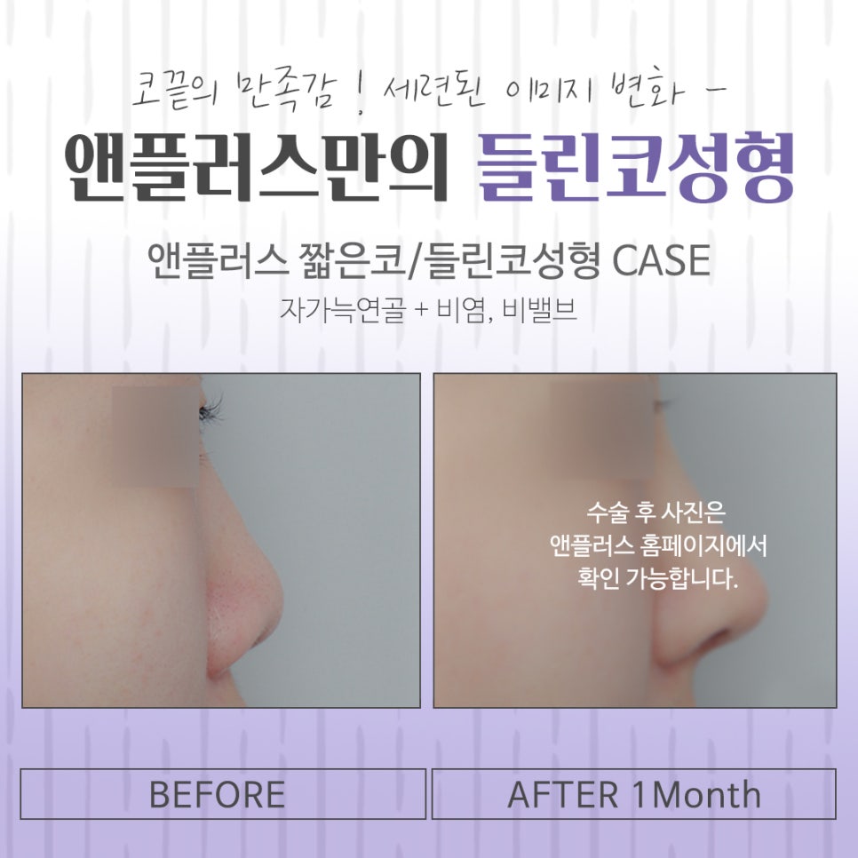 들린코성형 후기를 자세하게 알아보고 관련 이미지 15