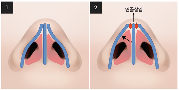 비염의 원인과 해결 방법! 관련 이미지 20