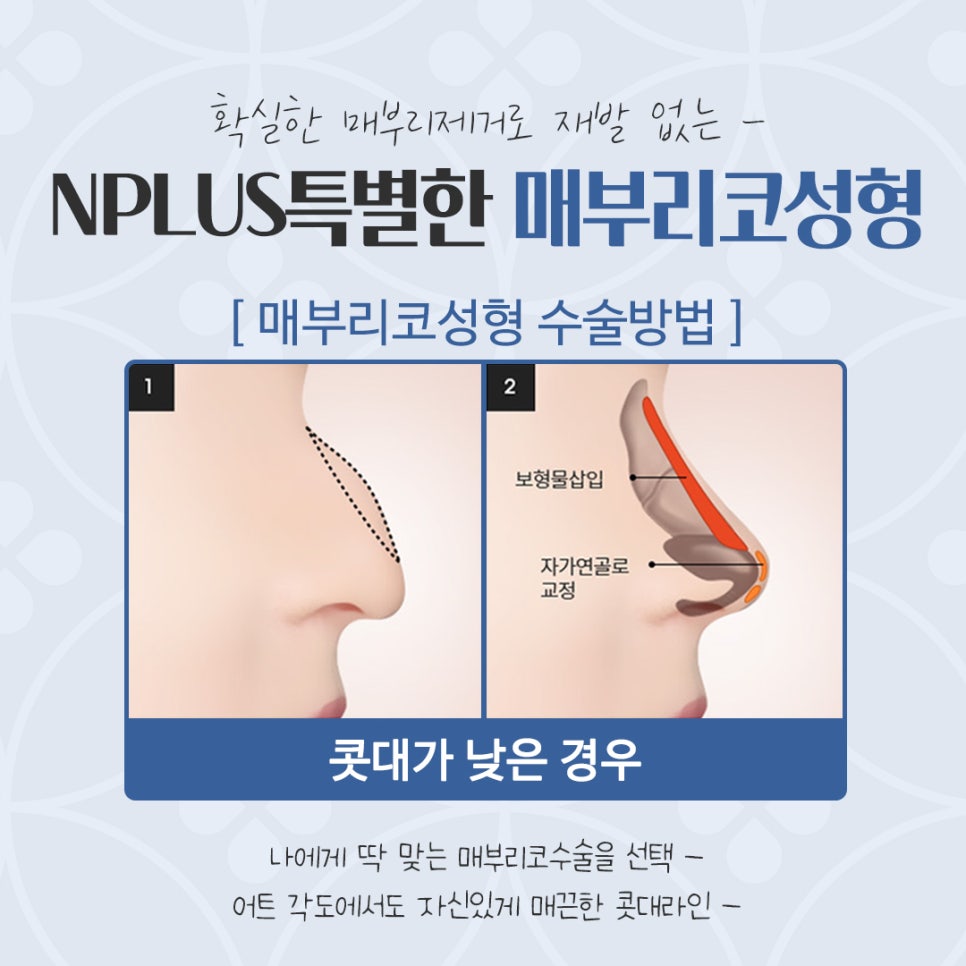 Hump Nose Surgery Review with an Accurate Diagnosis image 10