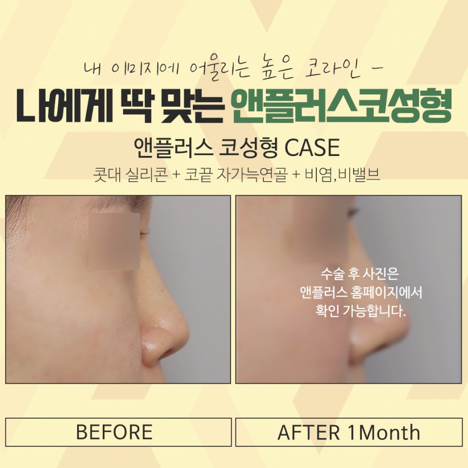 Nose Surgery Review Using Autologous Cartilage image 17