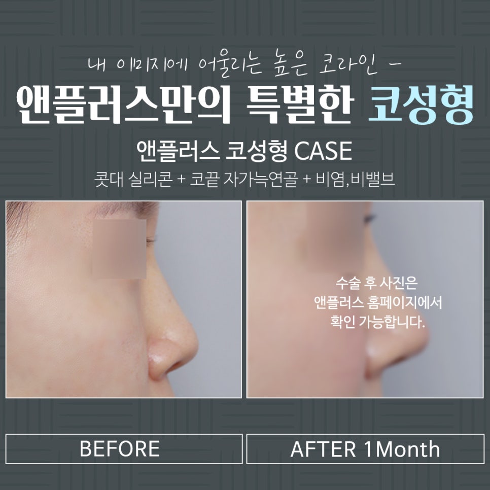 코수술전후 확실한 차이 관련 이미지 14