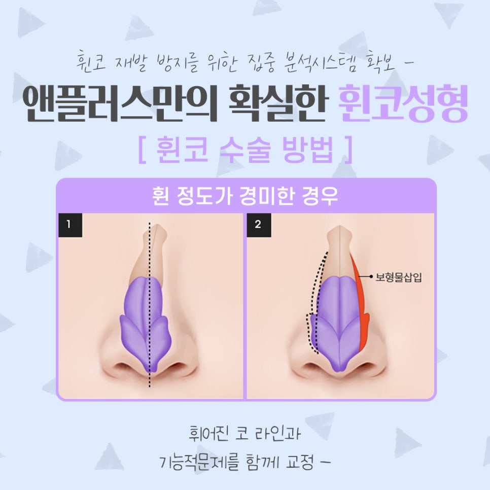 Taking a Thorough Look at Functional Deviated Nose Surgery image 9