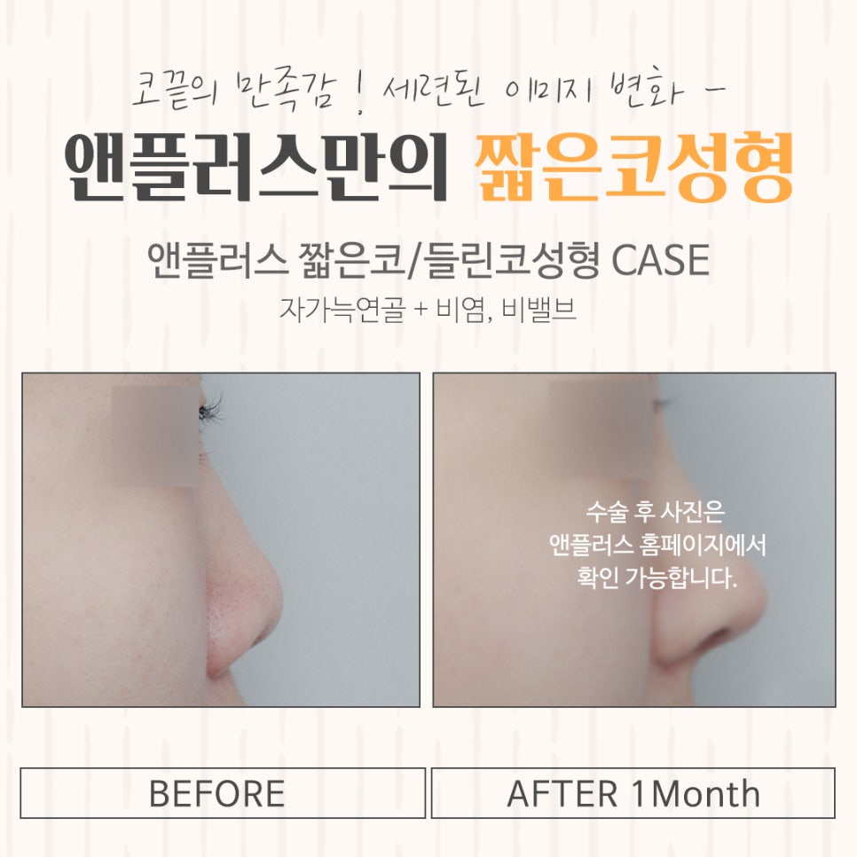Carefully Checking Short Nose Surgery image 15