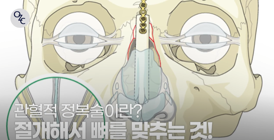 코뼈골절의 원인과 수술 방법에 대하여 관련 이미지 11
