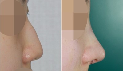 매부리코수술(무보형물, 절골, 코끝성형) 관련 이미지 1