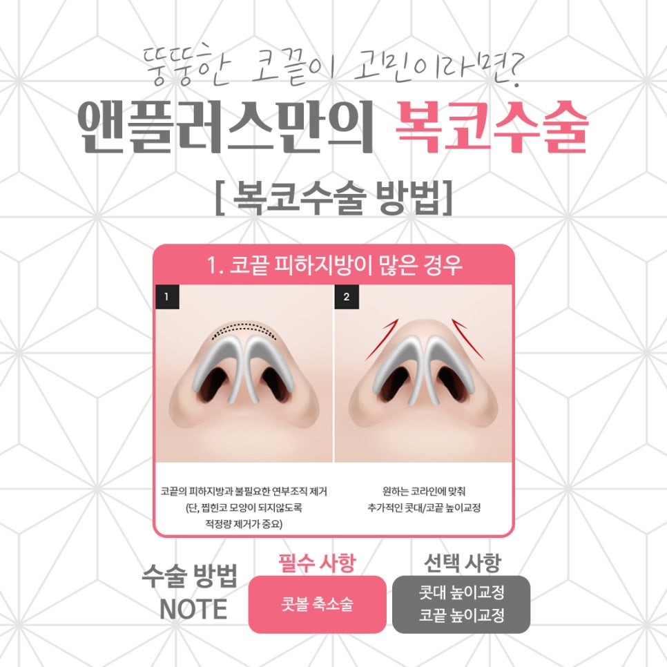 복코수술후기 뚱뚱한 코끝 개선 관련 이미지 5