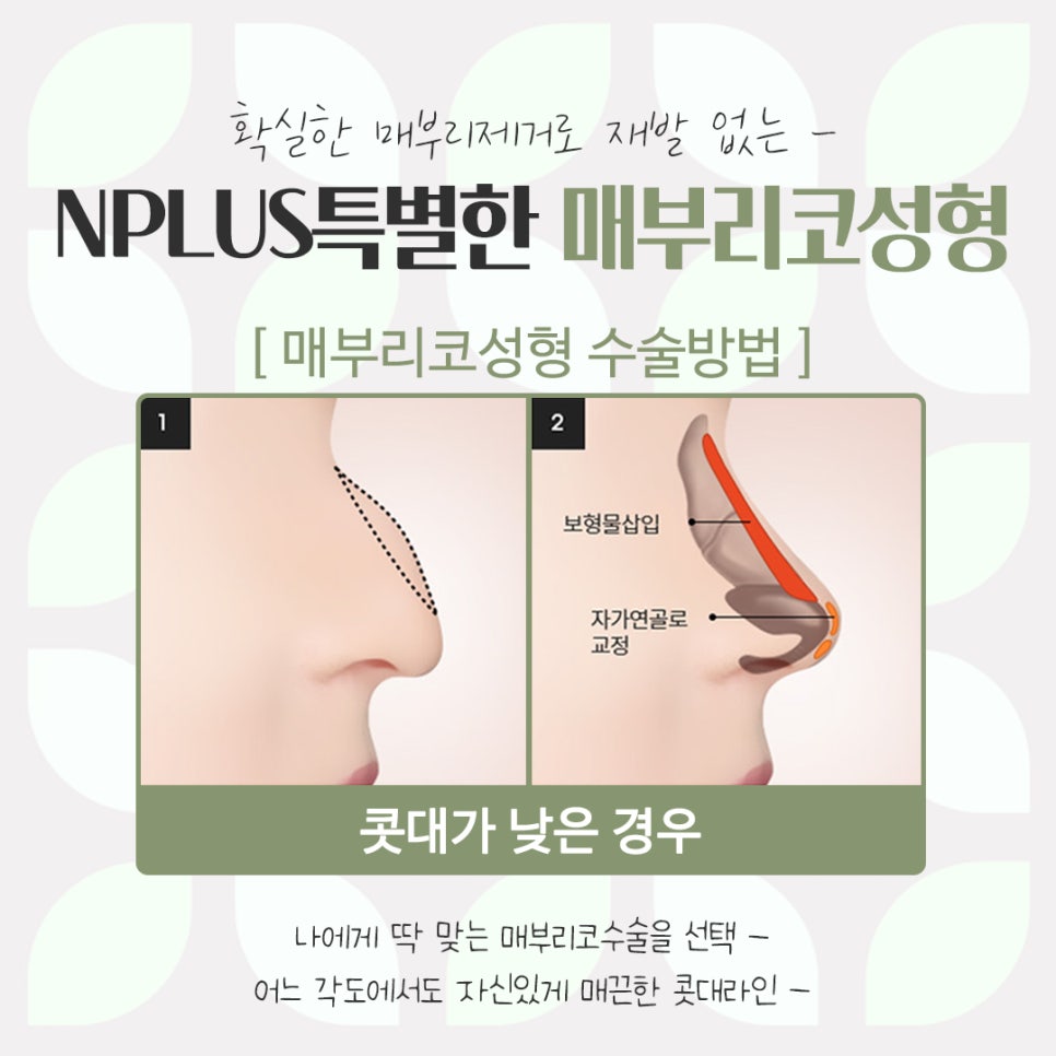Detailed Hump Nose Surgery Review image 11
