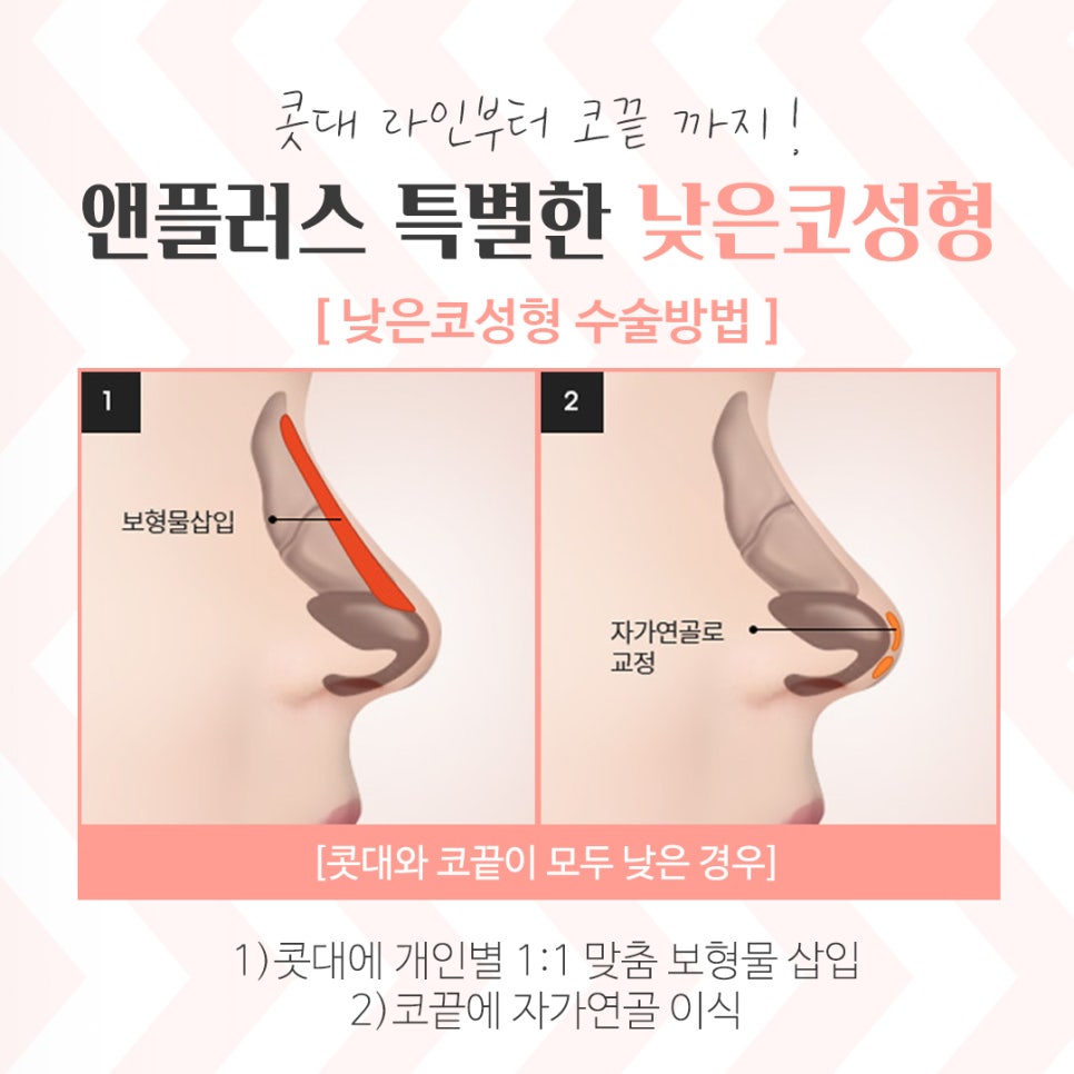 낮은코수술 여러 가지 사항을 고려하여 관련 이미지 7