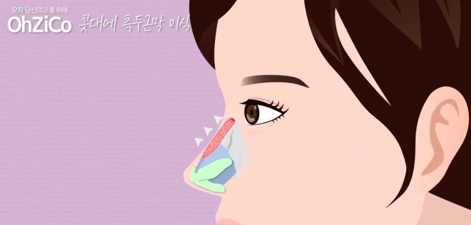 콧대성형에 사용되는 자가보형물 관련 이미지 13