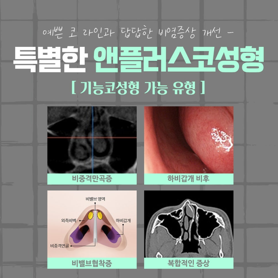 강남코수술후기 확실하게 알아보고 관련 이미지 6