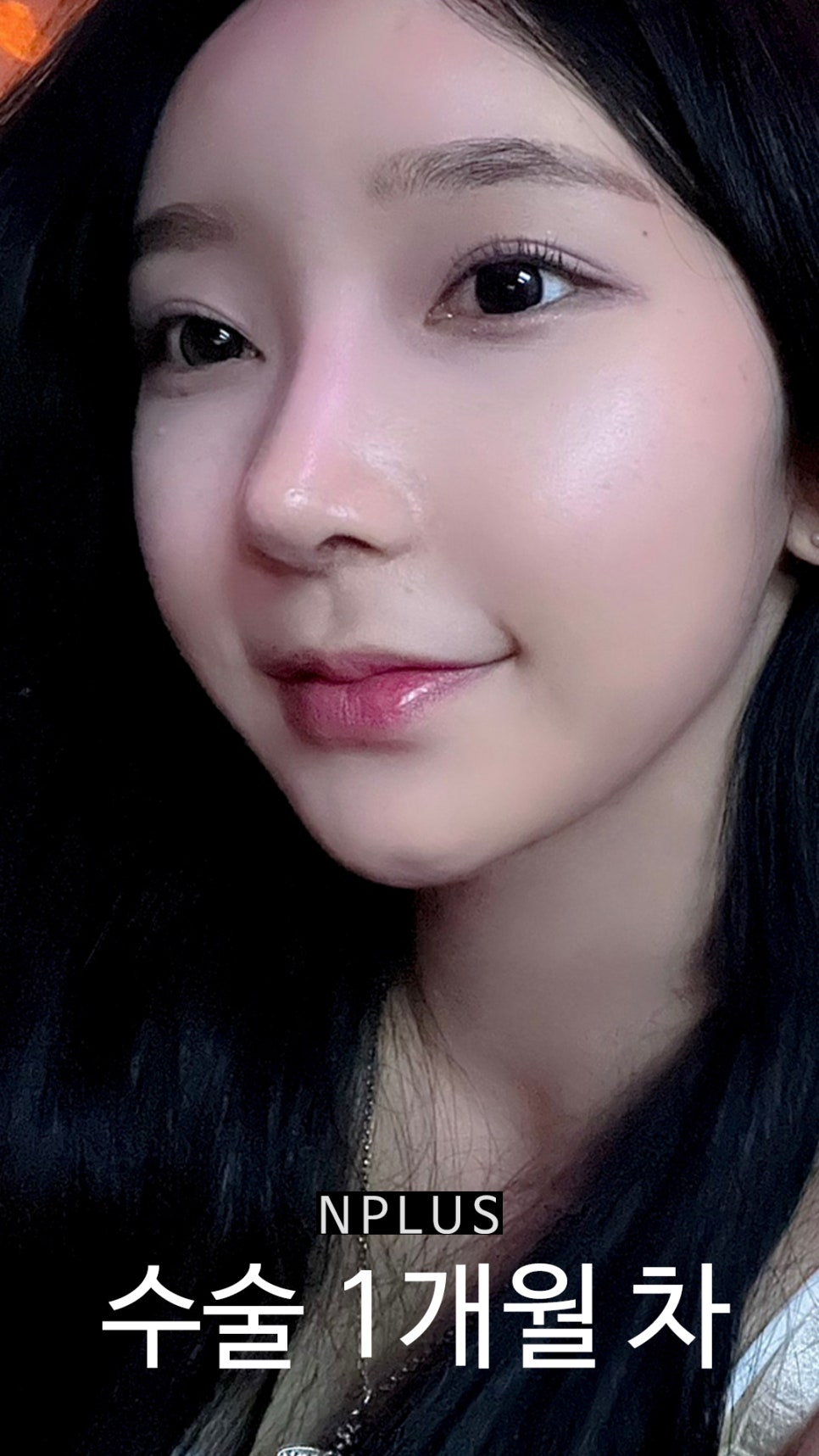 기본코성형후기 절골 + 무보형물 코성형 + 코끝 비중격 연골, 귀 연골 관련 이미지 8