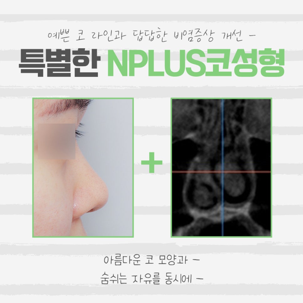 낮은코성형 후기에 대해 알아보고 관련 이미지 3