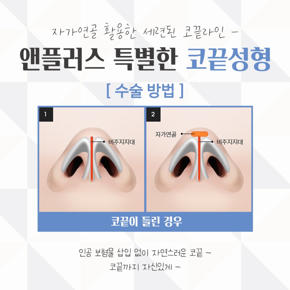 Nose Tip Surgery Review: Natural Results with Nose Tip Cartilage Stitching image 10