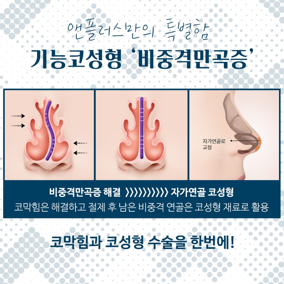 Septoplasty for Satisfying Results image 3