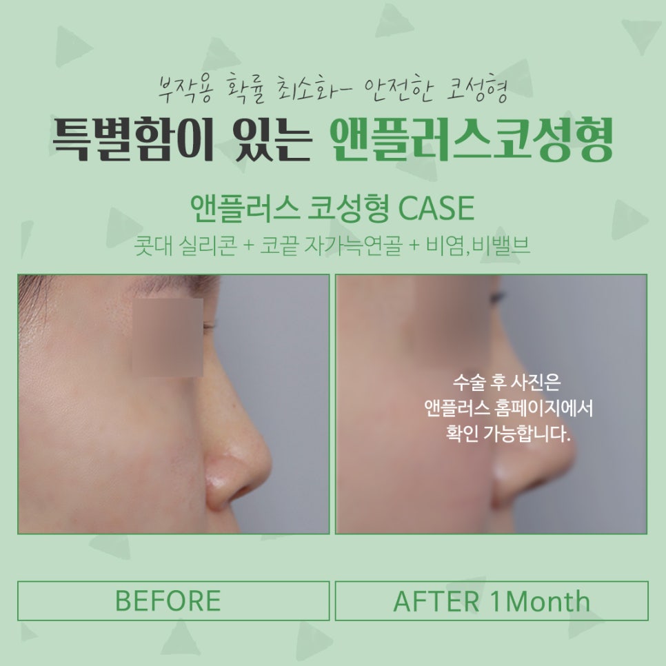 코성형후기 자연스럽고 예쁘게 관련 이미지 15