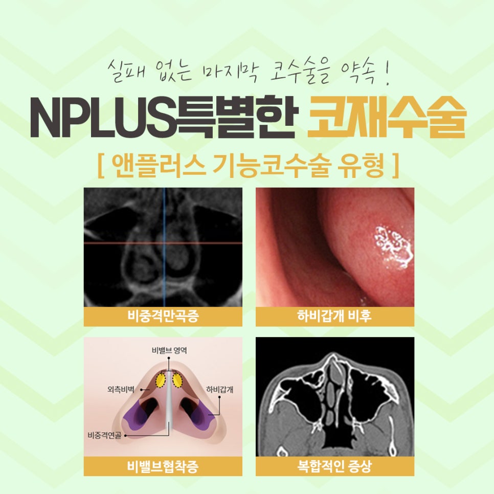 Nose Revision Surgery Review Considering Function as Well image 6