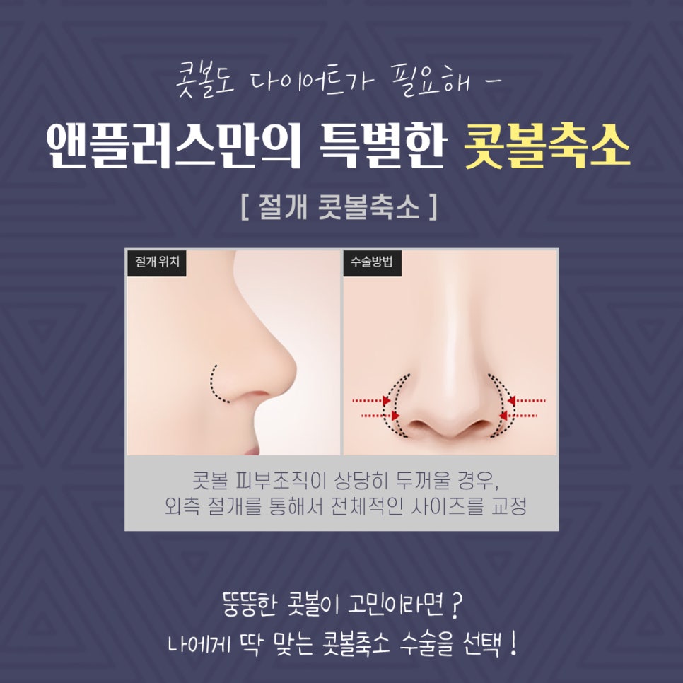 Non-Scar Alar Reduction to Improve a Bulbous Nose image 7