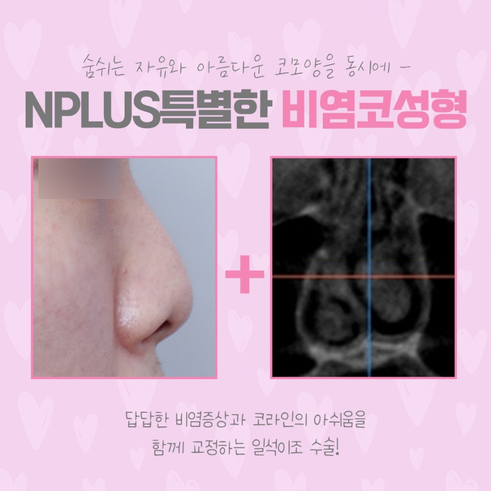 비염코수술 원인을 정확하게 파악하고 관련 이미지 6
