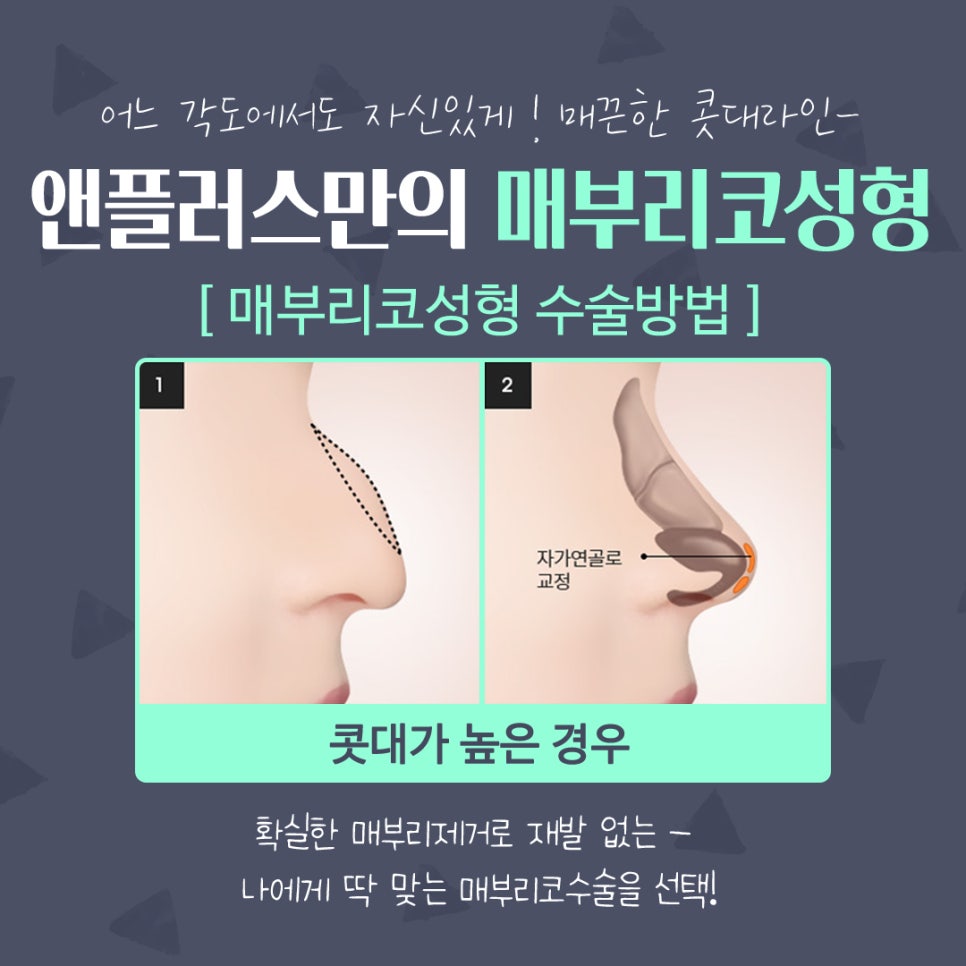 매부리코성형후기 매끈하고 예쁜코라인으로 관련 이미지 10