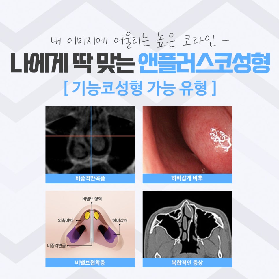 코성형후기를 다양하게 찾아보고 관련 이미지 5