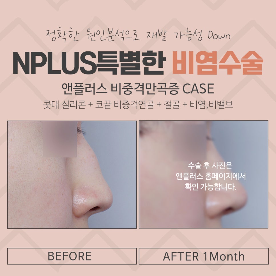 비중격수술후기 정확하게 파악해야 관련 이미지 16