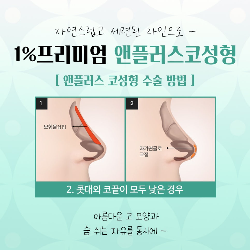늑연골코성형에 대해 자세히 알아보고 관련 이미지 9