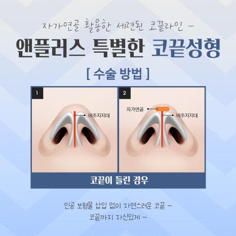 Looking into Comparisons of Tip Rhinoplasty Reviews image 8