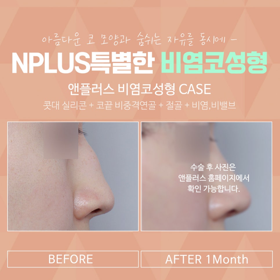 Nasal Surgery Review, Considering a Beautiful Nose Line image 6