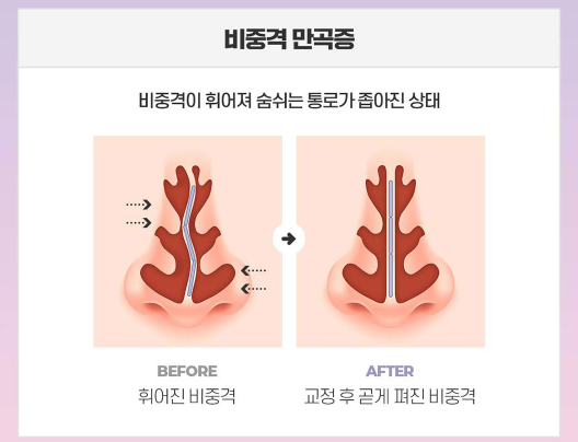 Learn More About Functional Rhinoplasty Events in Detail image 10