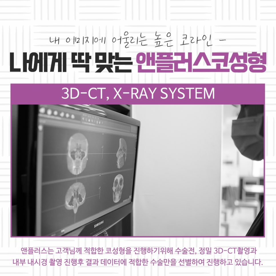 자가연골코성형을 통해 자연스럽고 예쁜 라인으로 관련 이미지 6