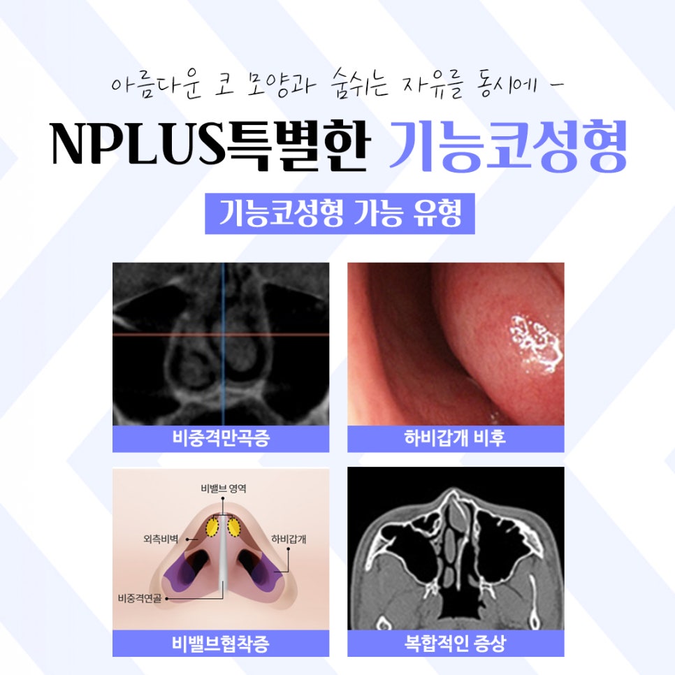 기능코성형후기 다양한 변화를 확인하여 관련 이미지 5