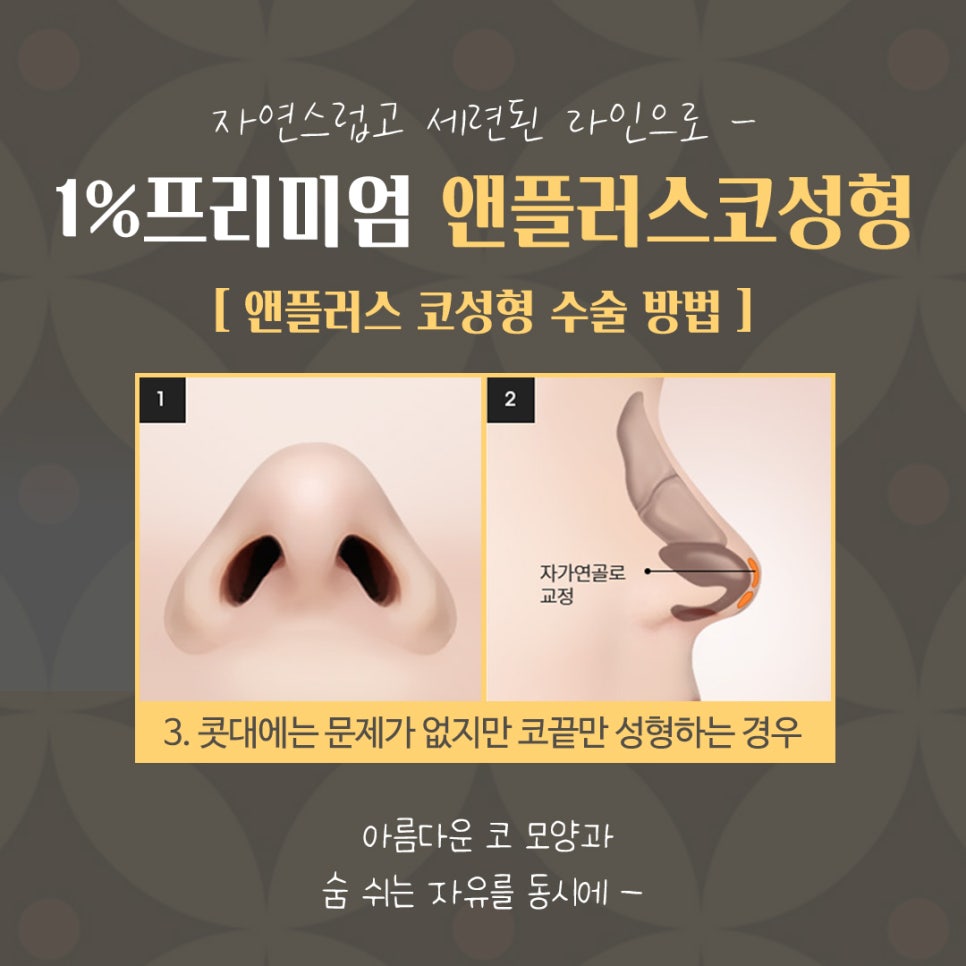 자가늑연골코성형으로 세련된 이미지로 변신 관련 이미지 10