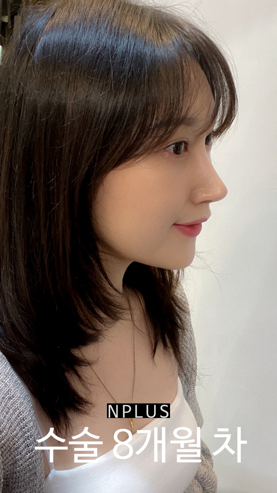 앤플러스에서 진행된 매부리코성형후기 관련 이미지 12