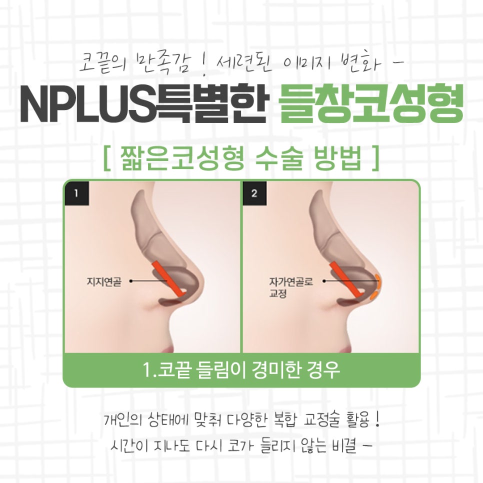 들창코성형 차이를 확인하고 관련 이미지 7