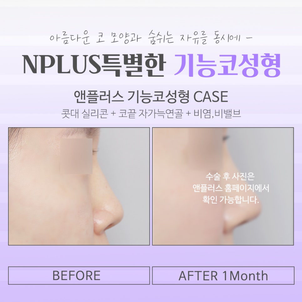 기능코성형후기에 대한 체크리스트 관련 이미지 15