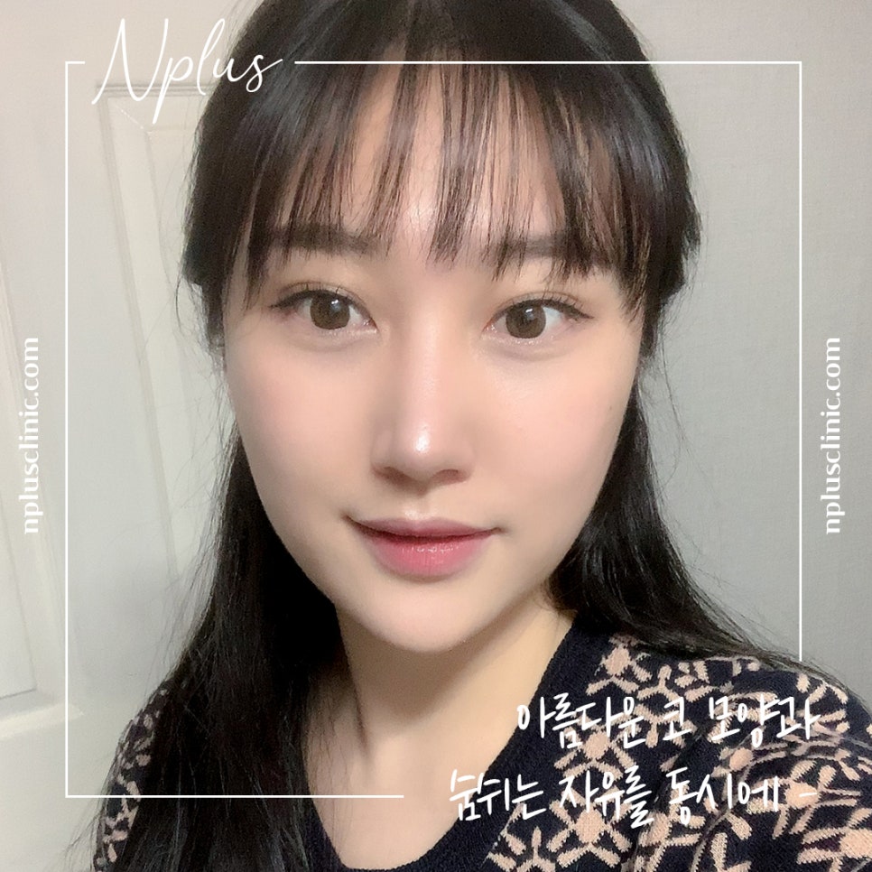 Reviewing Nostril Reduction Results and Improving Your Appearance image 11