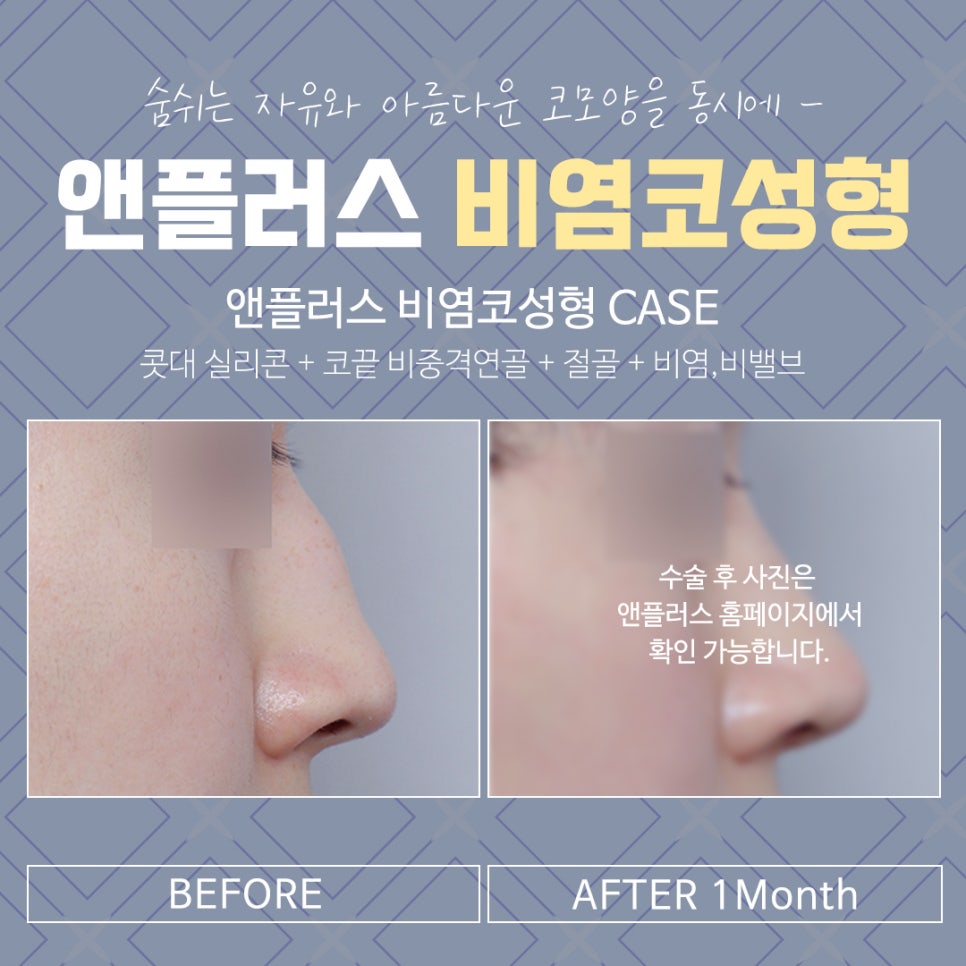 Review of Rhinoplasty for Rhinitis: Check and Decide image 15