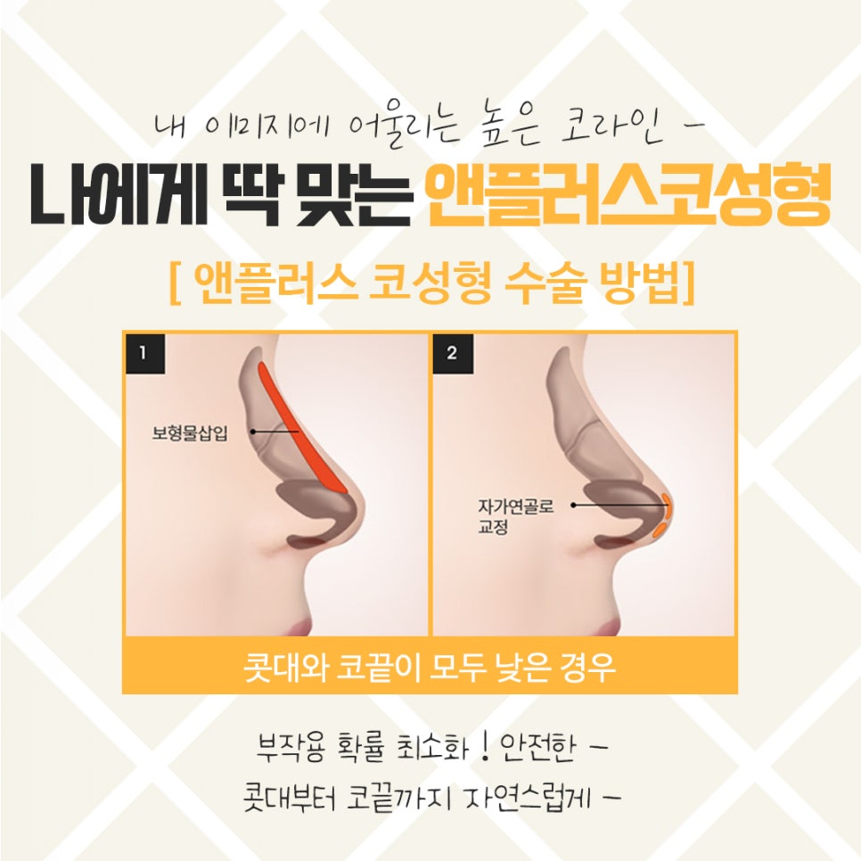 코뼈골절수술 자세하게 알아봐야 관련 이미지 7