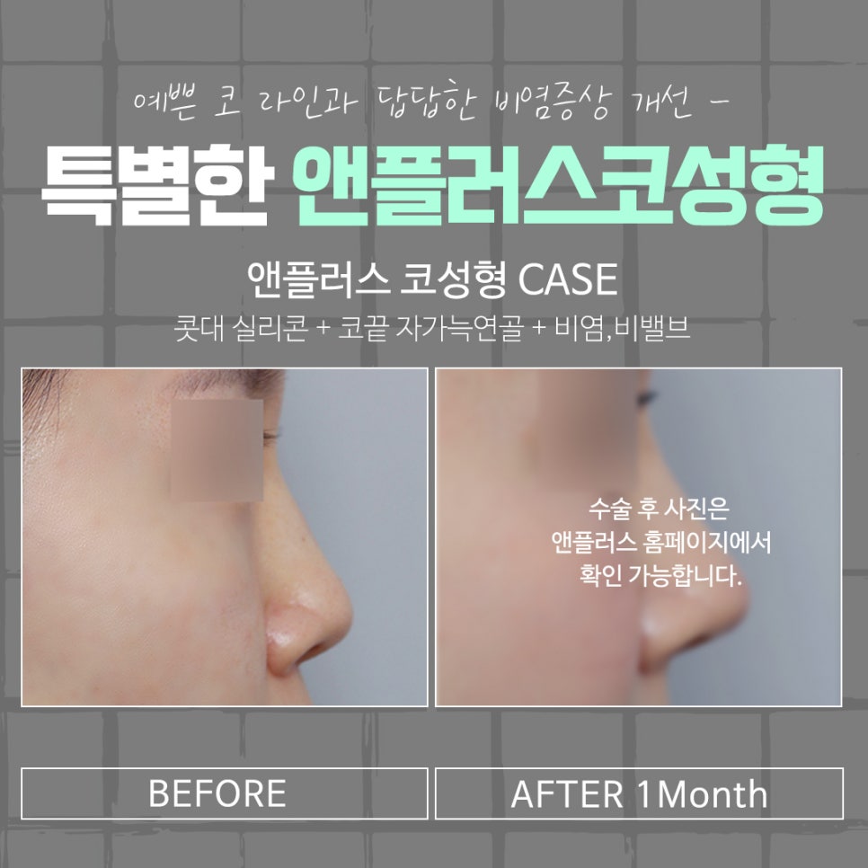 강남코수술후기 확실하게 알아보고 관련 이미지 14