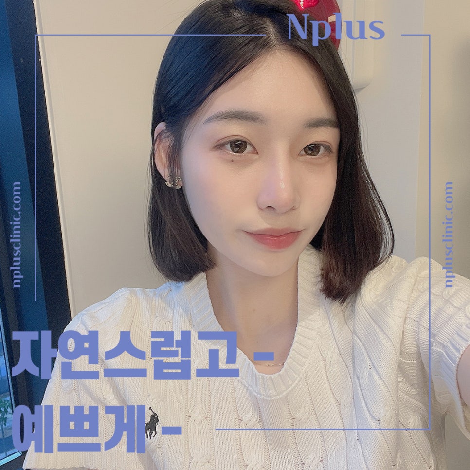 Post-Operative Review of Bulbous Nose Surgery, Improved Naturally image 1
